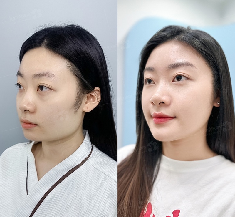 Người có góc hàm to, thô cứng 