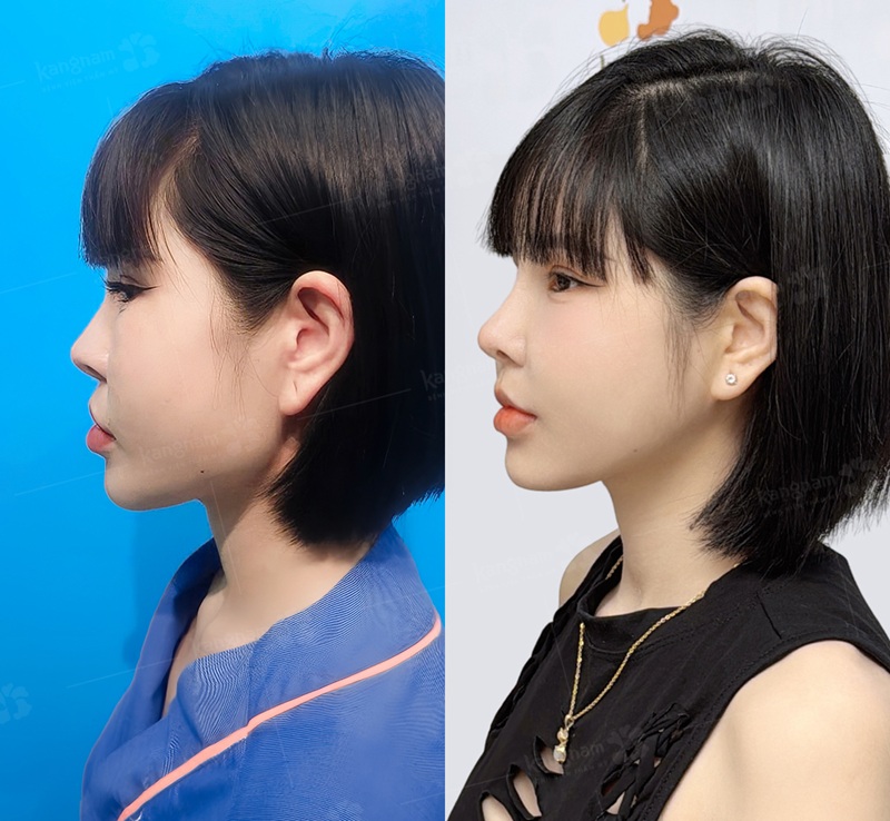 Cằm gọn và thon hơn sau khi gọt hàm