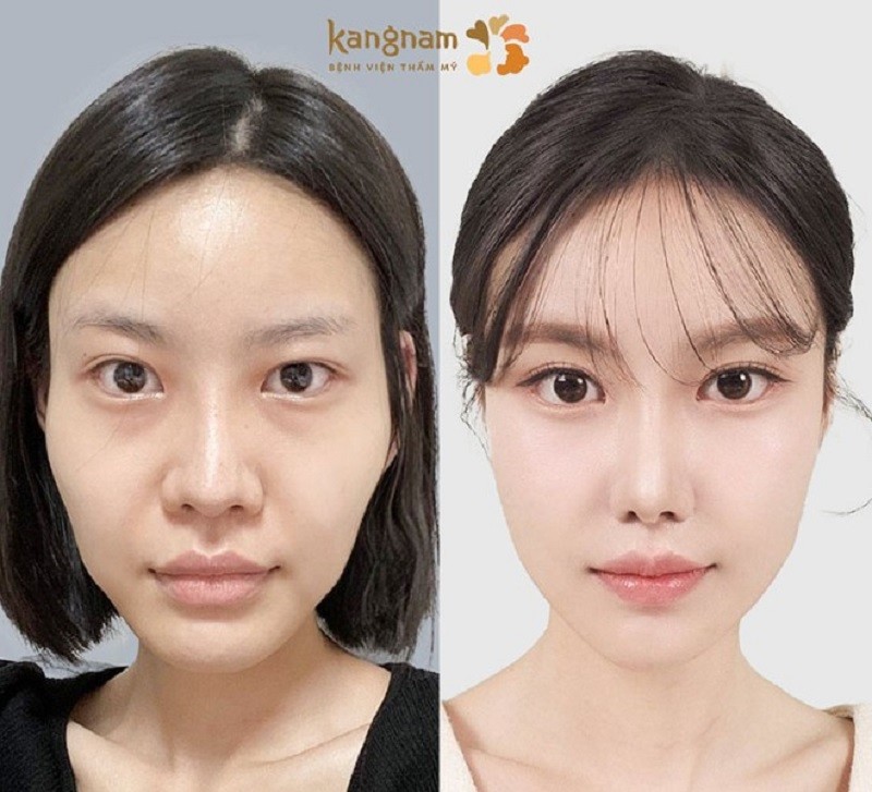 Nên hạ gò má khi gương mặt không cân đối, gò má cao