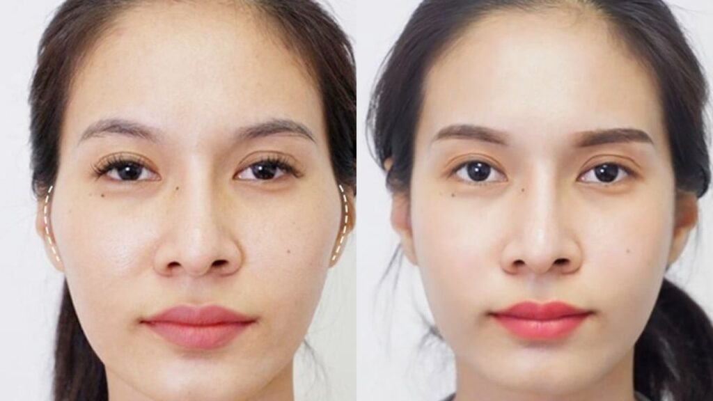 Hạ gò má tại TP.HCM: Nên làm ở đâu, cần lưu ý gì để tránh rủi ro?