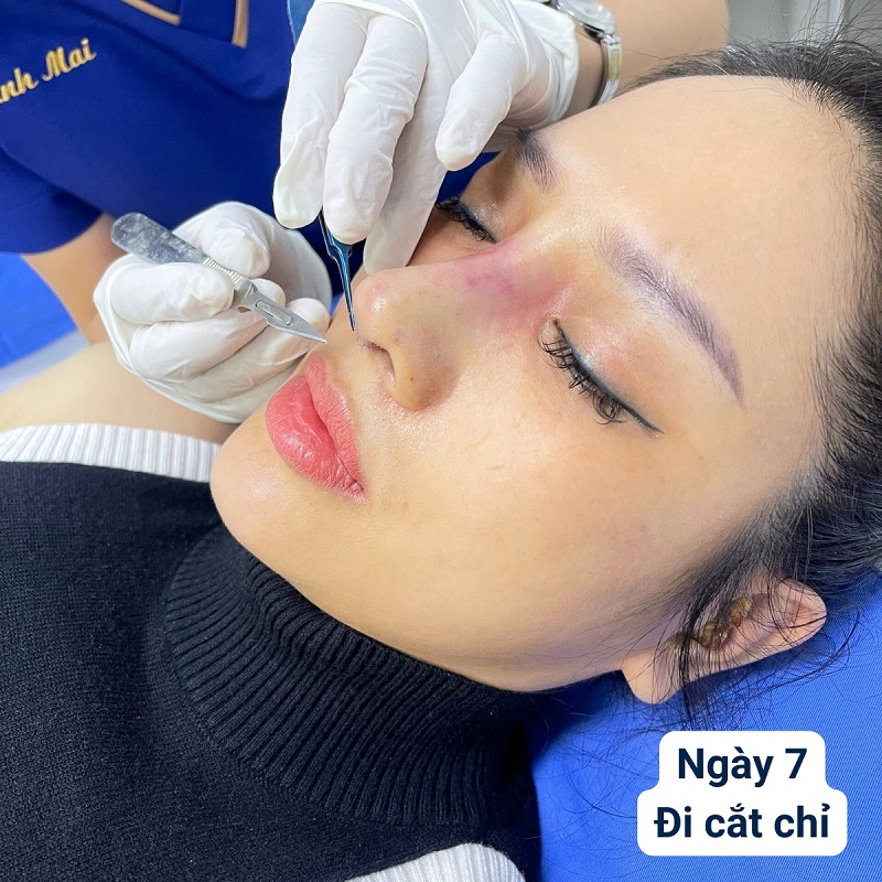 Sau khoảng 7 - 10 ngày dáng mũi đã ổn định hơn và khách hàng có thể cắt chỉ