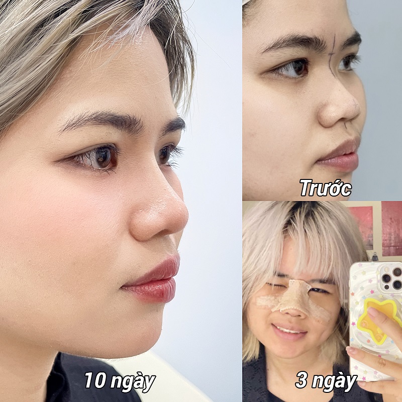 Mũi sưng bầm, hơi nề là triệu chứng thường gặp sau nâng mũi