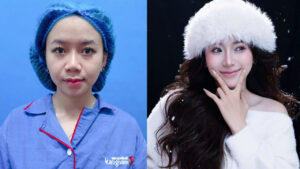 Hình ảnh sau nâng mũi: Kết quả thực tế có đúng như mong đợi?