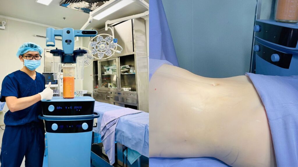 Hút mỡ ở đâu đẹp tại Sài Gòn? Tiêu chí lựa chọn địa chỉ uy tín