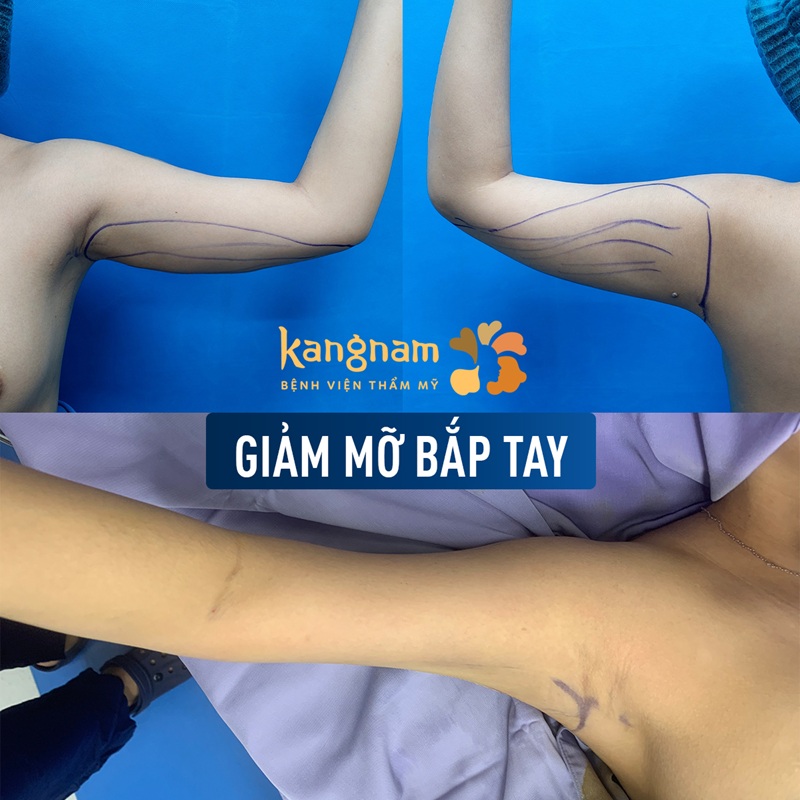 Bắp tay thon gọn, giảm hết mỡ xấu