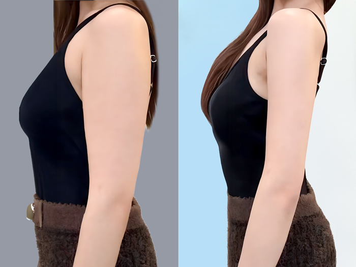 hút mỡ bắp tay giá thường thấp hơn vì vùng hút nhỏ