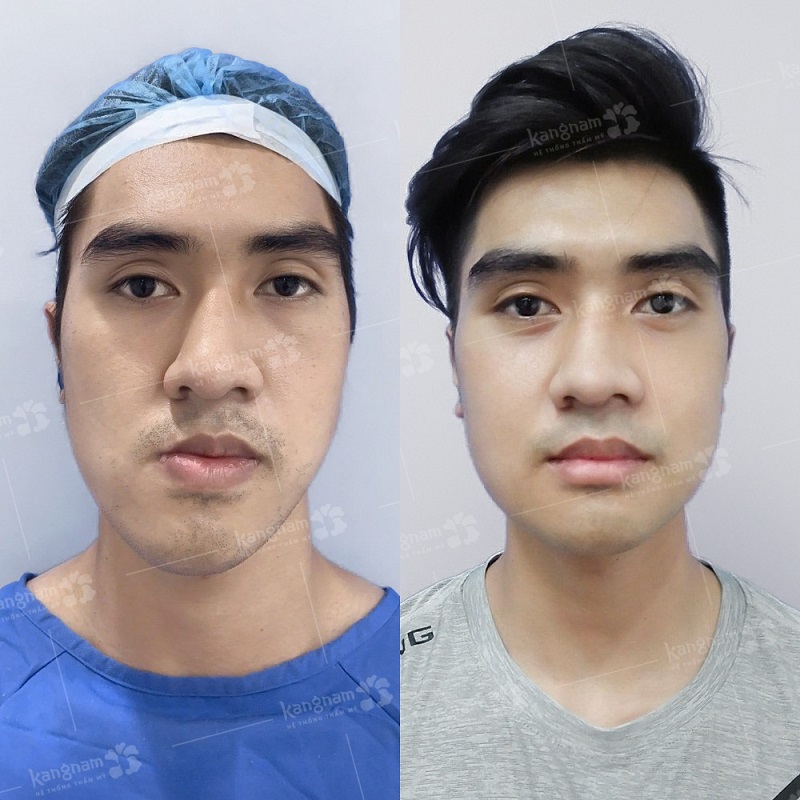 Vết mổ được thực hiện bên trong khoang miệng nên không để lại sẹo