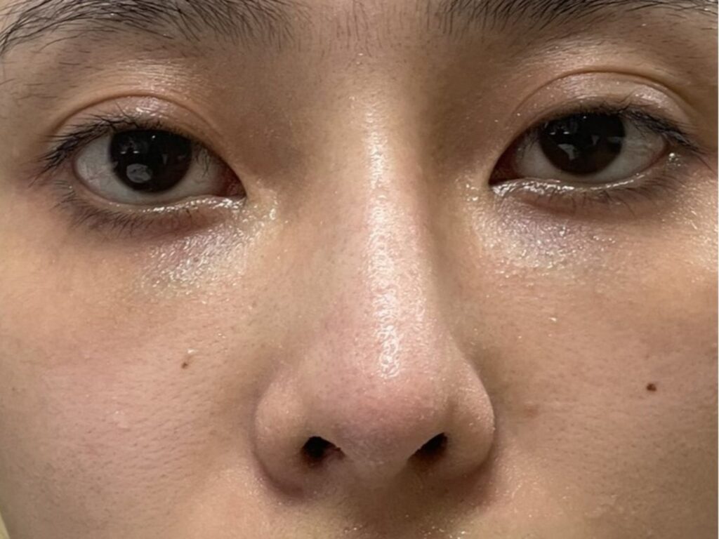 Các khuyết điểm mũi thấp tẹt hếch gồ và biến dạng cần can thiệp phẫu thuật cấu trúc