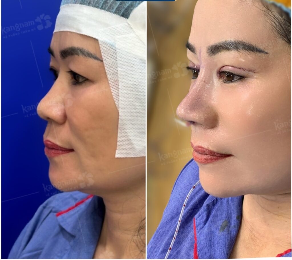 Kết quả nâng mũi bọc sụn tự thân cho người lớn tuổi giúp duy trì tuổi thọ dáng mũi vĩnh viễn