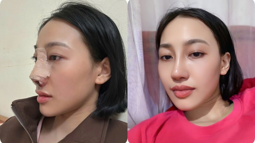 Cảnh báo: Làm mũi có nguy hiểm không? Những điều không được bỏ qua