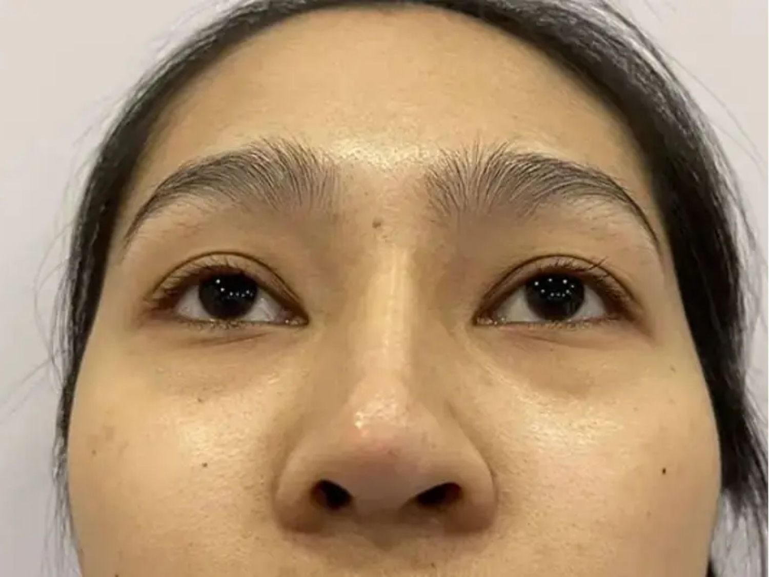 Mũi lệch là biến chứng khá hiếm gặp sau phẫu thuật nâng mũi, do bác sĩ đặt sụn không chính xác