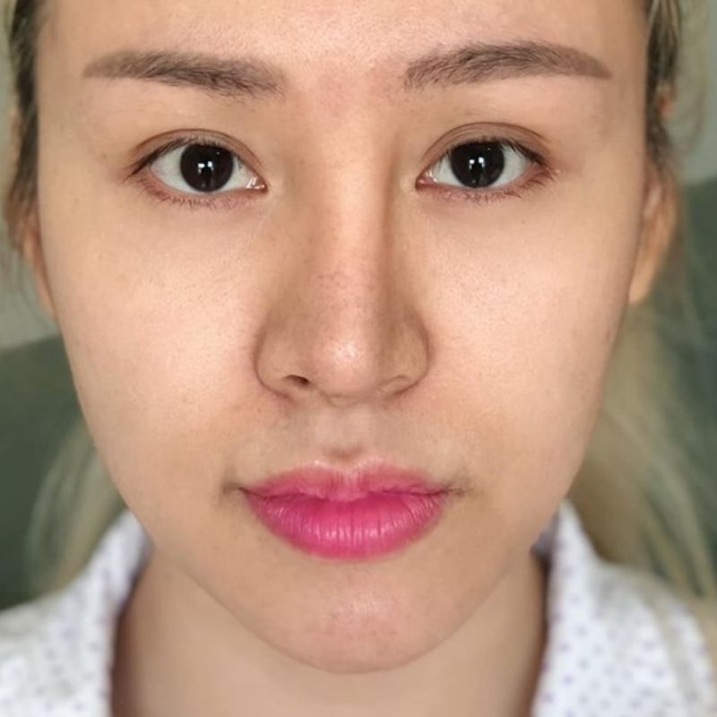 Mũi lệch là rủi ro rất hiếm gặp