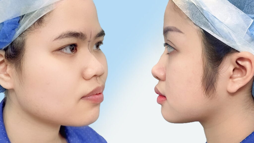 Cách nhận biết các dáng mũi phổ biến: mũi gãy, mũi quặp, mũi hếch, mũi lân