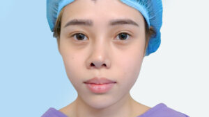 Mũi to một bên bé một bên là gì? Nguyên nhân và cách khắc phục