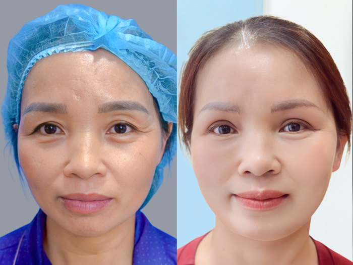 khách hàng sở hữu nếp mí đều sau cắt mí và loại bỏ da chùng, nếp mí tự nhiên và bền đẹp nhiều năm