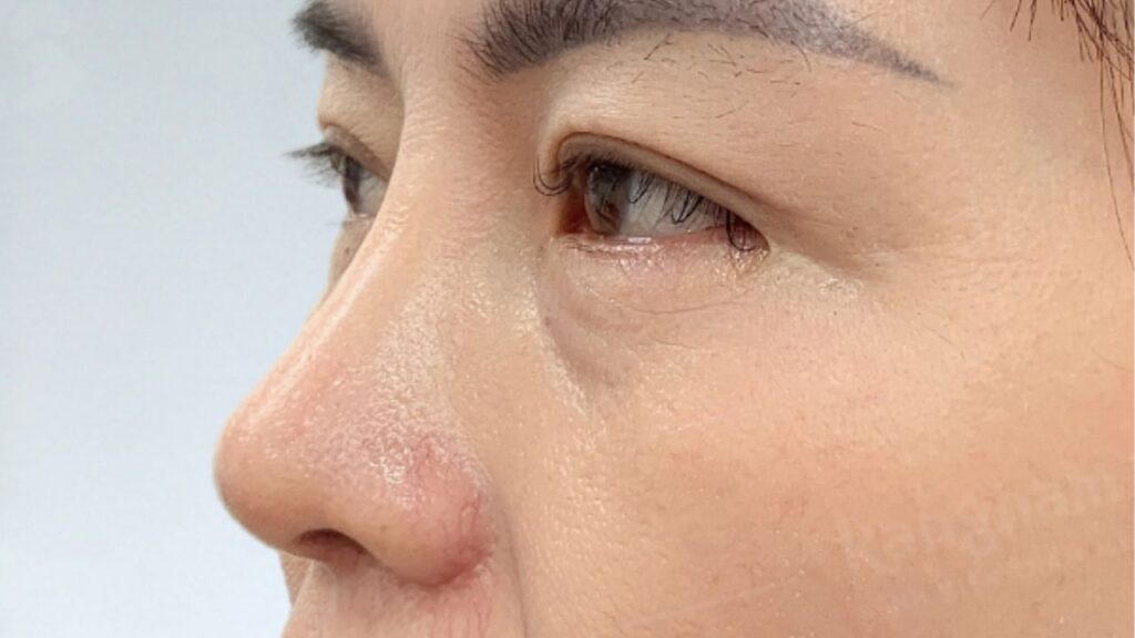 Nâng mũi 6D là gì? Đặc điểm, hiệu quả và những điều cần biết