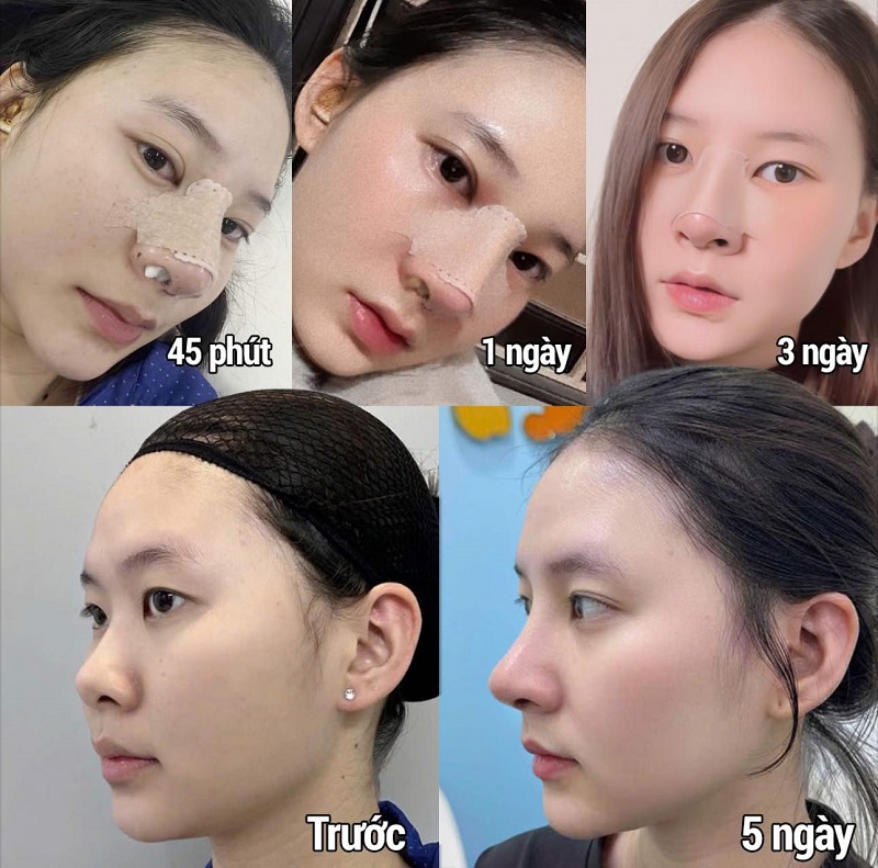 Sự thay đổi rõ rệt của dáng mũi qua các cột mốc thời gian hồi phục.