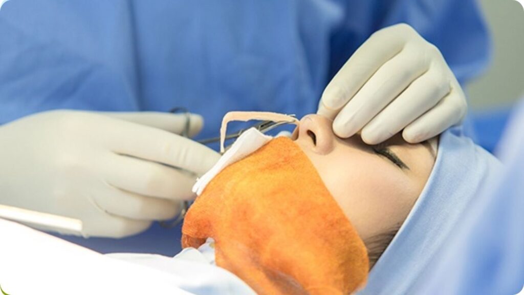 Nâng mũi có tháo ra được không? Có ảnh hưởng gì đến mũi không?