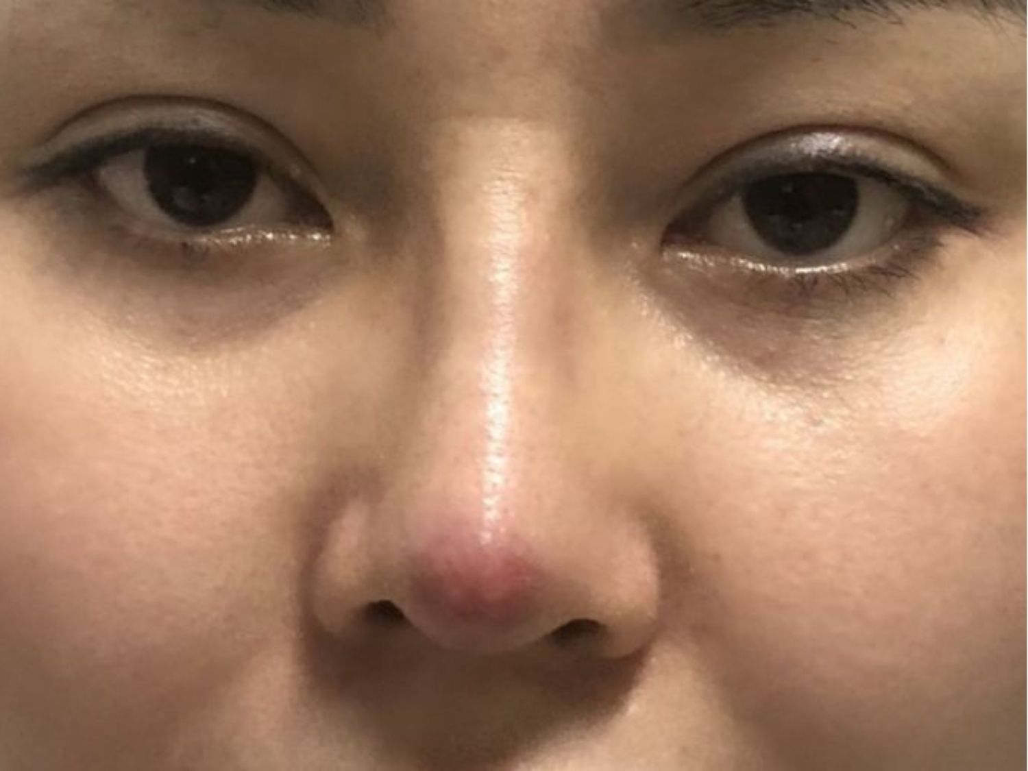 Mũi lệch cần tháo sụn