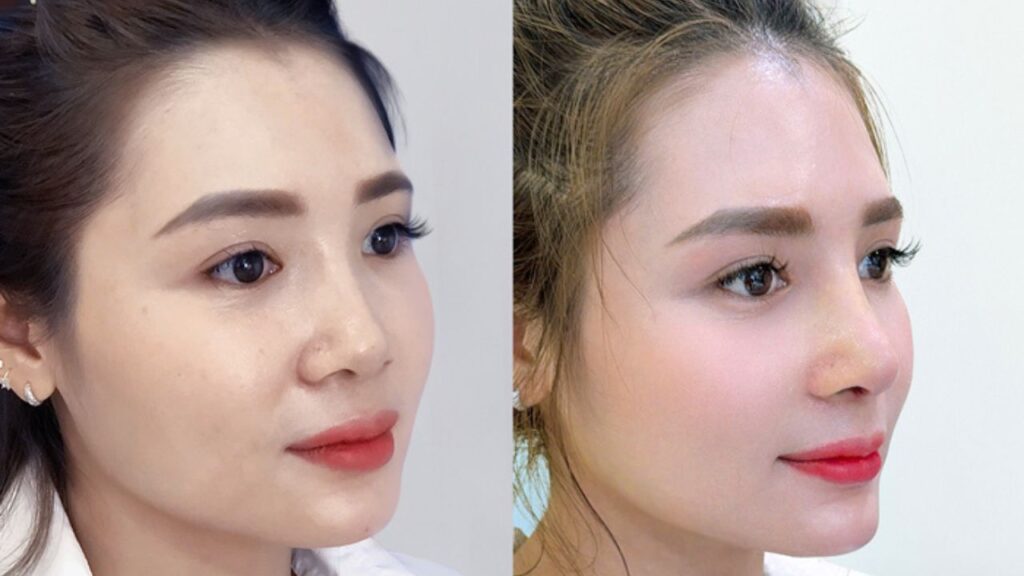 Nâng mũi có tự nhiên không? Tiêu chí quyết định kết quả sau khi làm