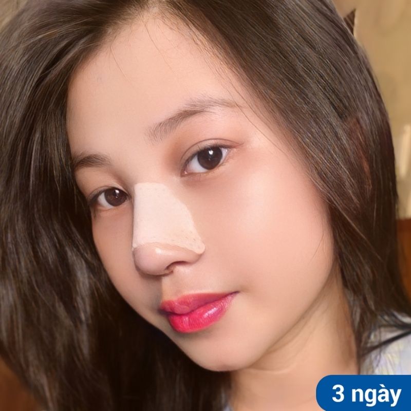 Dáng mũi sau 3 ngày, sưng ít, dần hồi phục