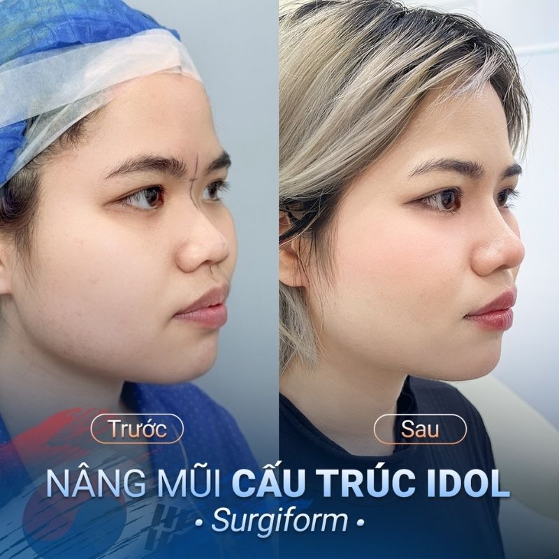 Sửa mũi ngắn, hếch có thể áp dụng phương pháp nâng mũi cấu trúc