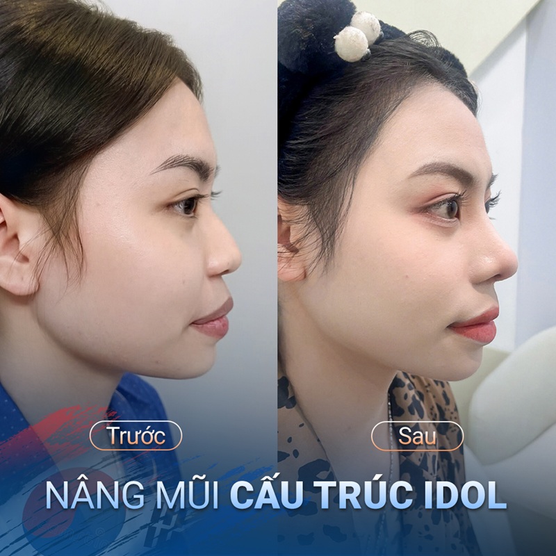 Nâng mũi cấu trúc Idol cho dáng mũi S-line 