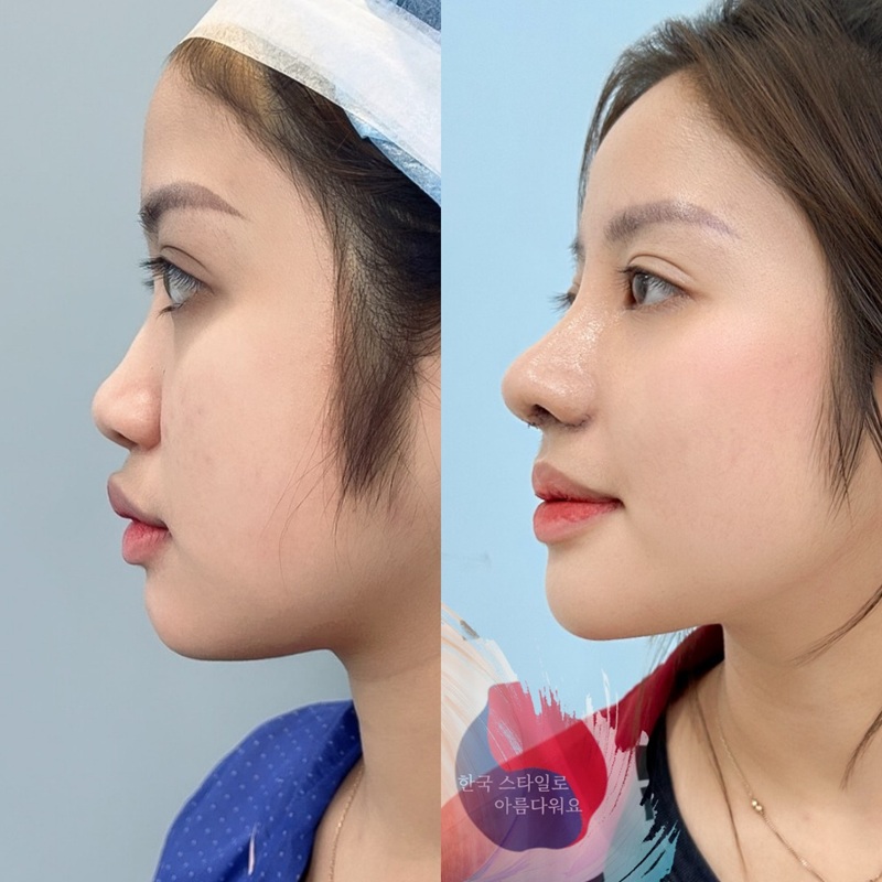 Nâng mũi sụn sườn tự thân khắc phục mũi hỏng nặng hiệu quả