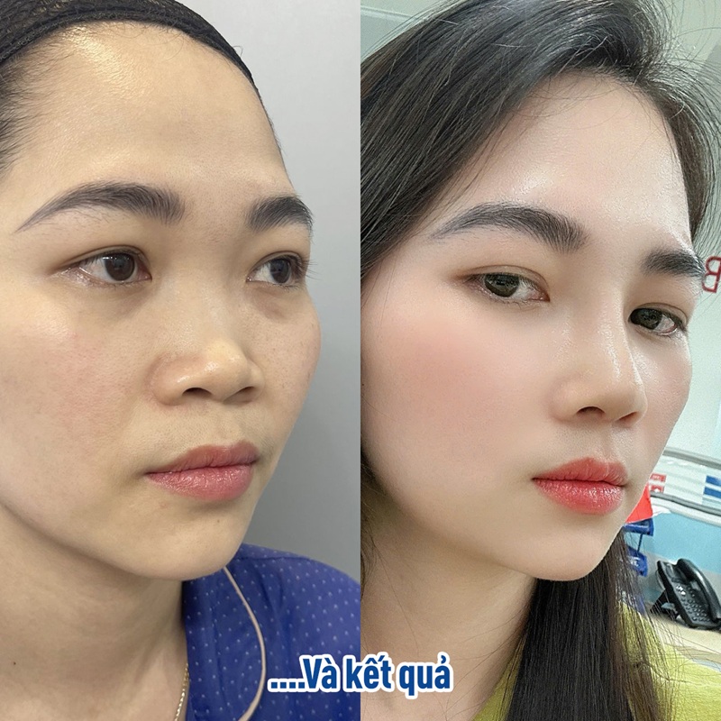 Mũi cao, gương mặt thon gọn hơn 