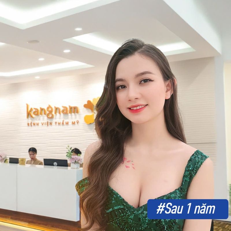 Ngực đẹp cân đối sau 1 năm