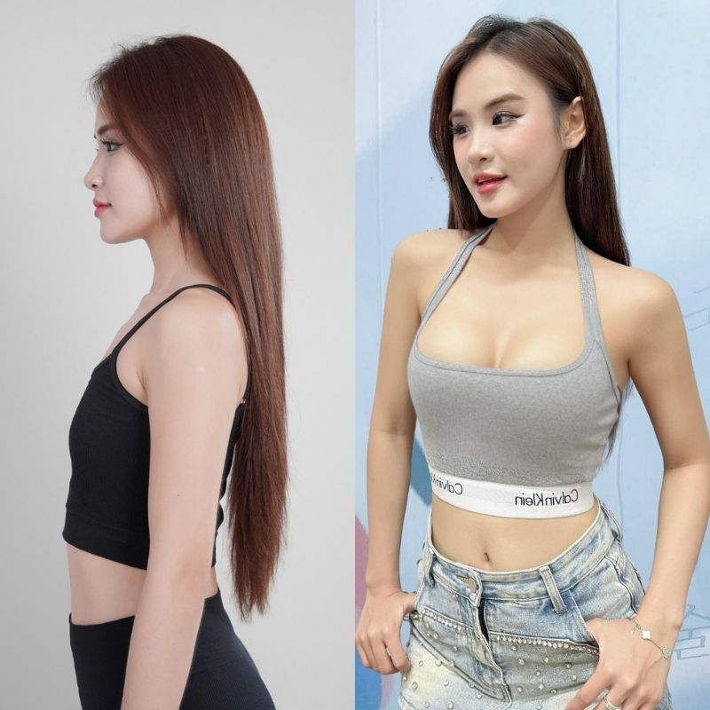 Ngực lép bẩm sinh, thiếu độ nhô nên chọn nâng ngực túi độn