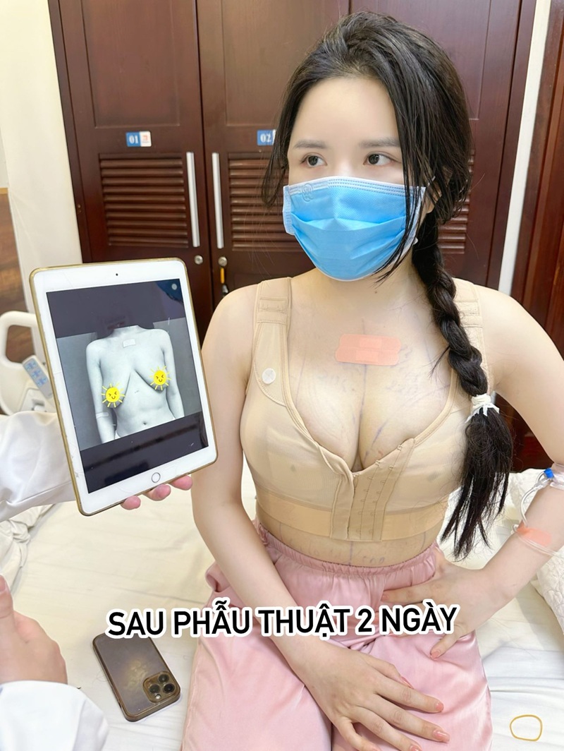Sự thay đổi sau nâng ngực 2 ngày tại Kangnam TP.HCM