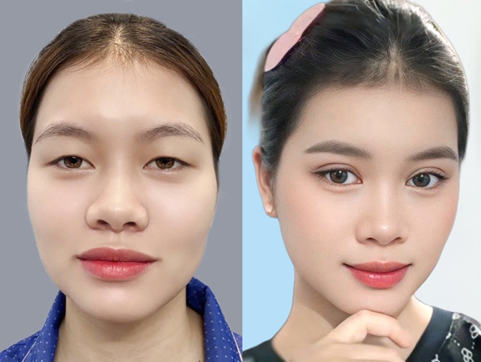 Cắt mí có hiệu quả lâu dài hơn nhấm mí