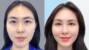 Nên cắt mí hay bấm mí? So sánh đúng để chọn phương pháp phù hợp với từng người