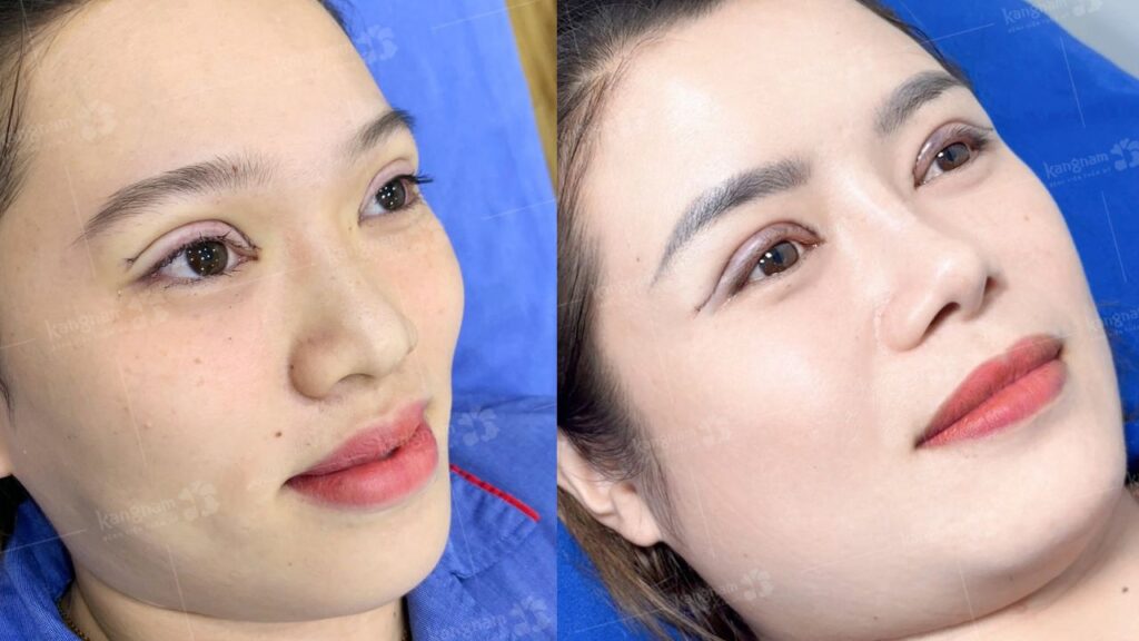 Những ai nên và không nên cắt mí – nhấn mí