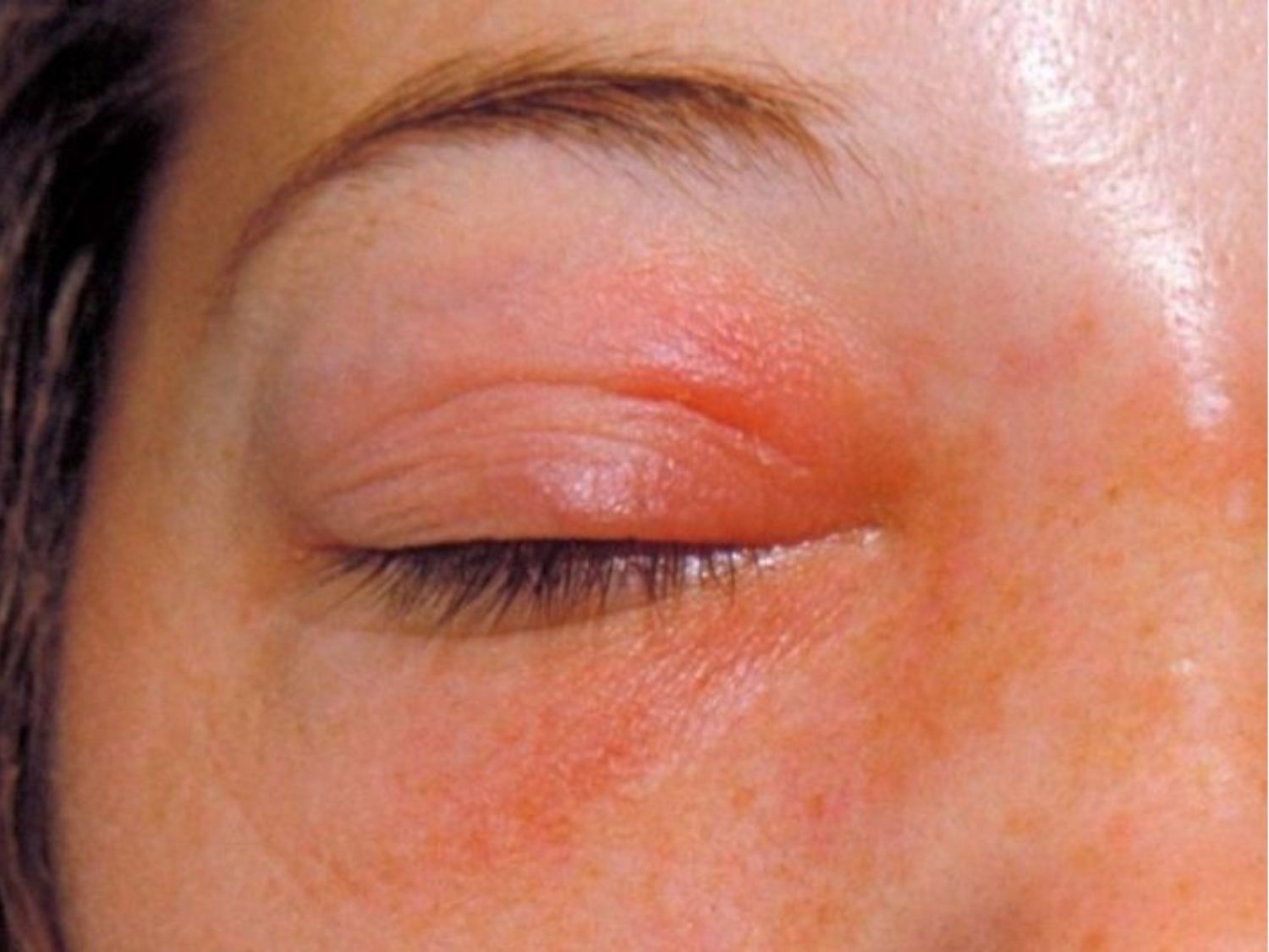 đây là tình trạng viêm nhiễm tại vùng mắt, mắt đang sưng đỏ, ngứa rát chưa phù hợp để thực hiện cắt mí