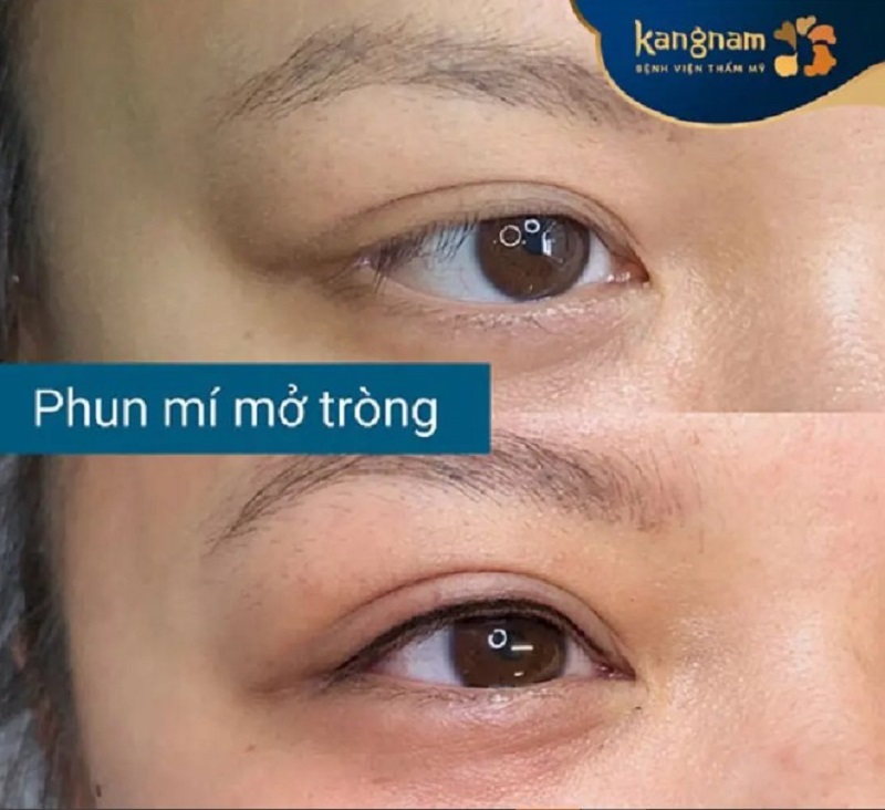 Mí mắt to tròn, sắc nét sau khi phun mí