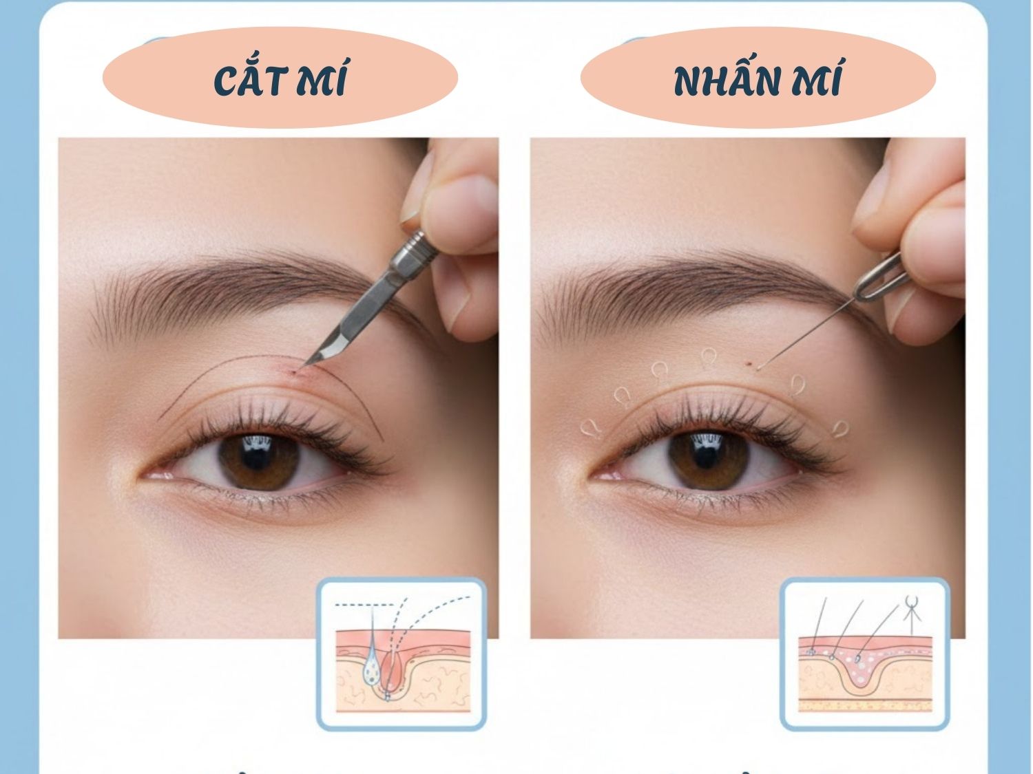 So sánh các phương pháp cắt mí phẫu thuật và cắt mí không phẫu thuật phổ biến hiện nay
