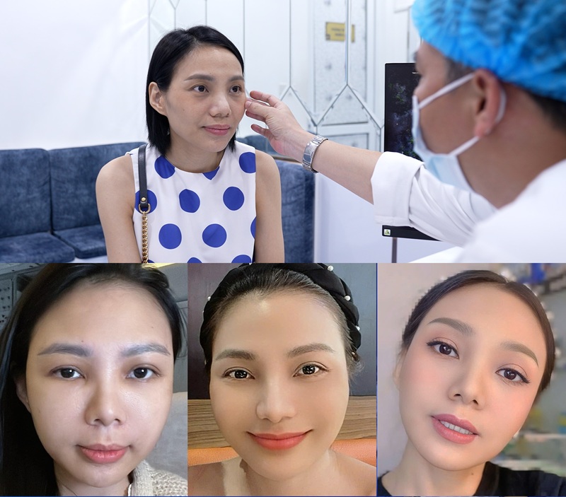 Cấy mỡ tự thân được thực hiện bởi đội ngũ bác sĩ giỏi