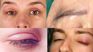 Rủi ro biến chứng khi thẩm mỹ mắt