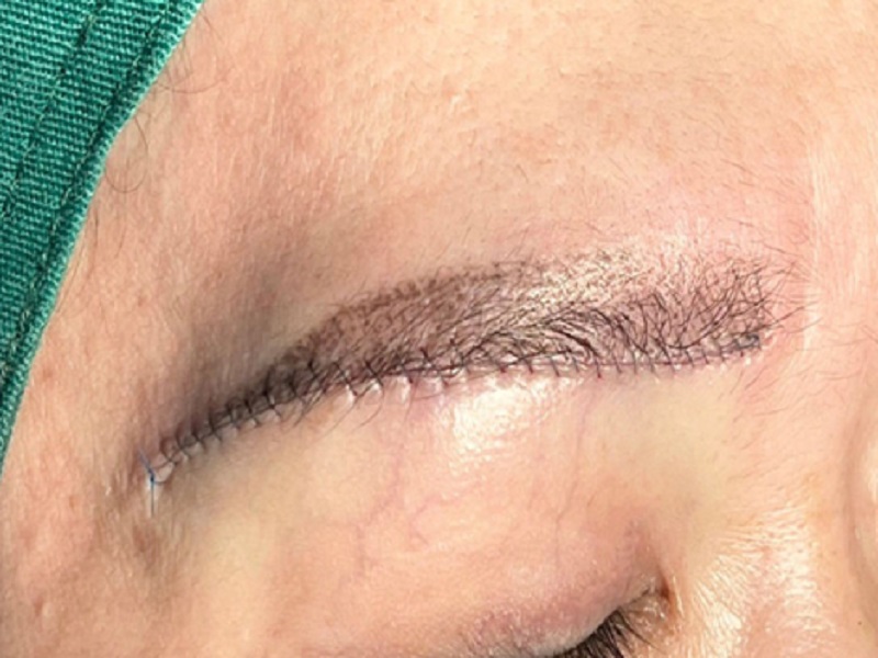 Dễ bị sẹo khi nâng cung mày không đúng kỹ thuật