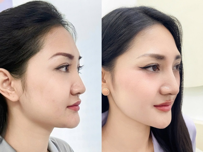 Chọn dáng mũi phù hợp với tỷ lệ khuôn mặt