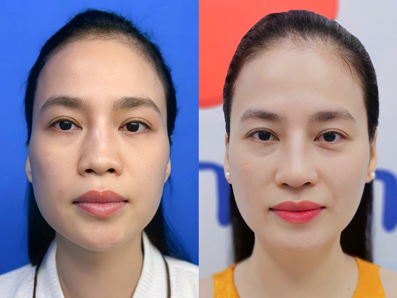 Mỗi khuôn mặt sẽ có dáng mũi phù hợp