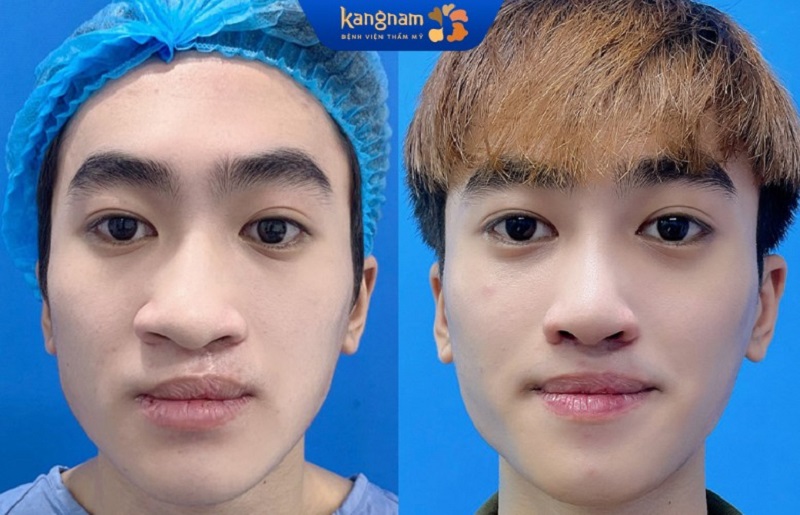 Nam giới khi nâng mũi tạo dáng cao thẳng, đầy nam tính