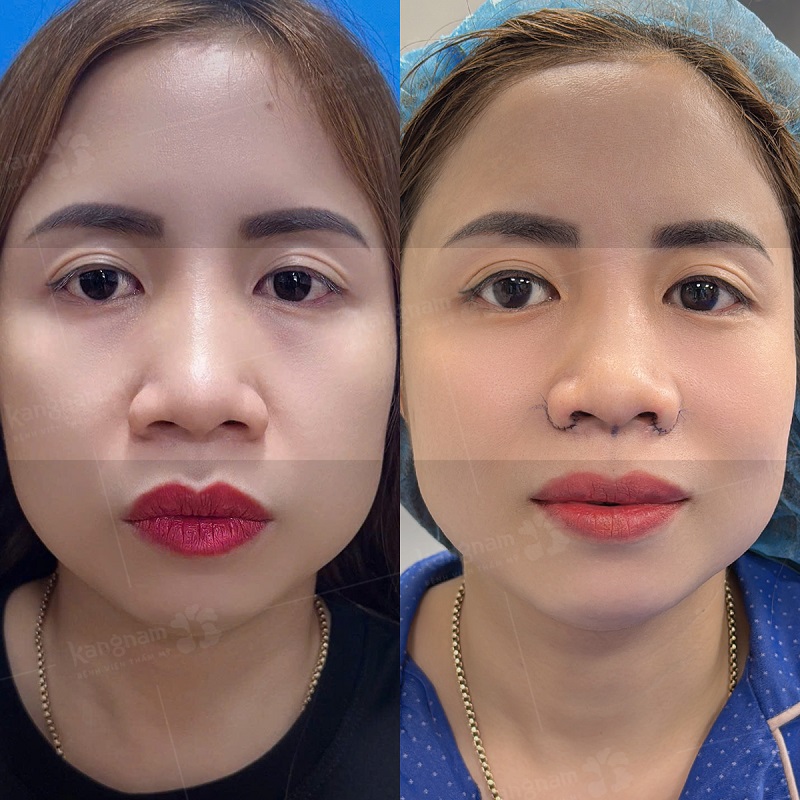 Lựa chọn dáng mũi sẽ giúp tôn lên đường nét của khuôn mặt