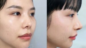 So sánh các phương pháp nâng mũi: Nên chọn cách nào phù hợp nhất?