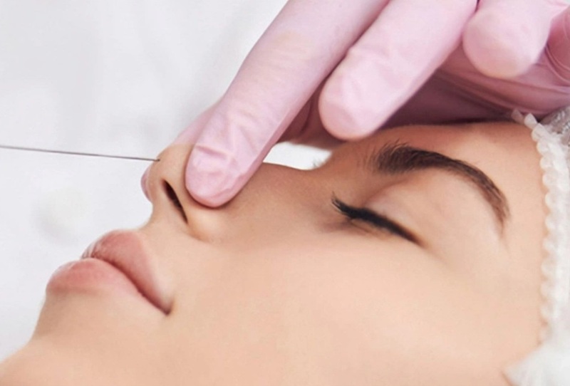 Nâng mũi không phẫu thuật chỉ phù hợp với những người mũi ít khuyết điểm