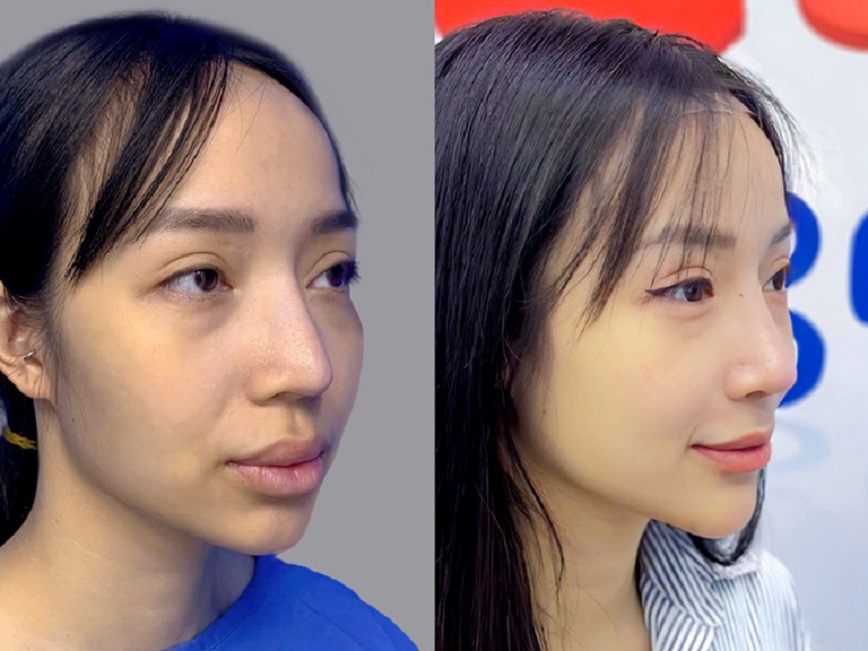 Phục hồi cấu trúc mũi sau khi sửa lại mũi hỏng