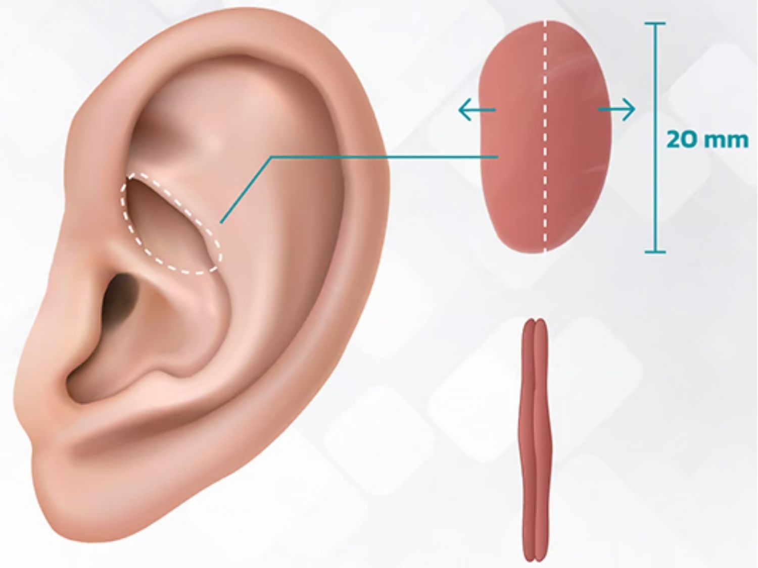 Ảnh minh họa vị trí lấy sụn tai nâng mũi, không làm thay đổi cấu trúc mũi