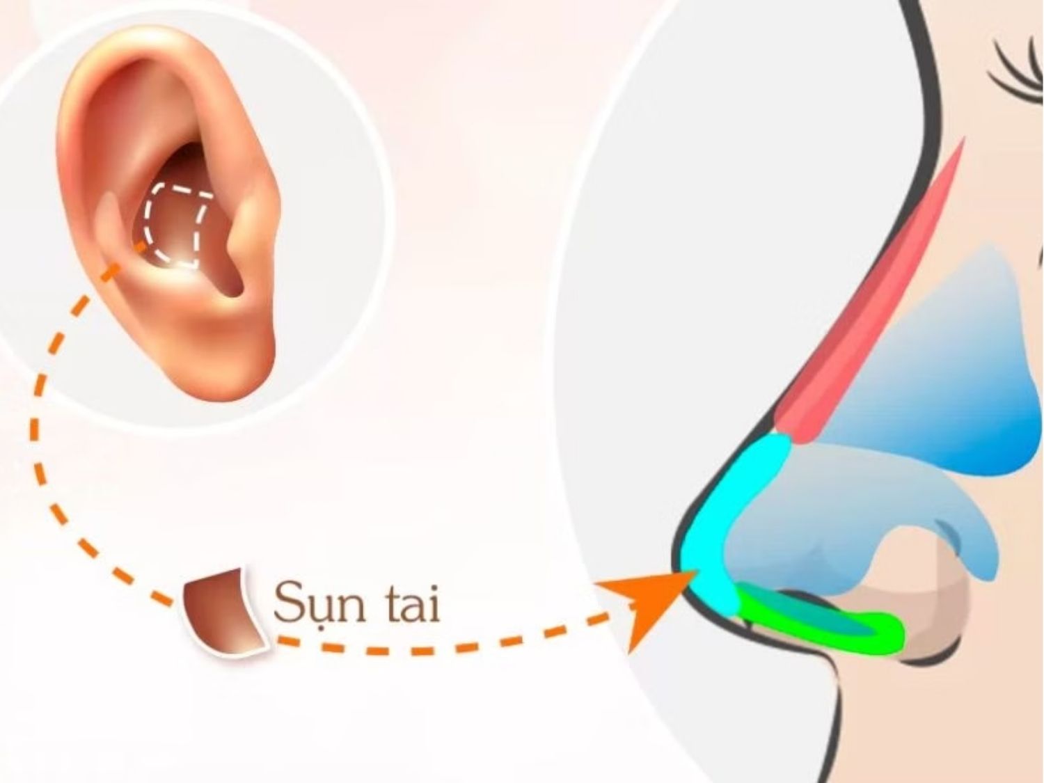 ảnh minh họa vị trí đặt sụn tai khi nâng mũi, dùng để bọc lót đầu mùi, hạn chế bóng đỏ